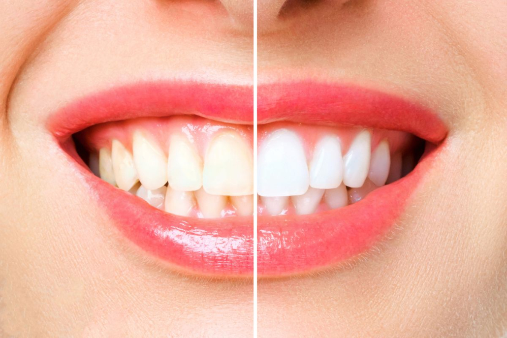 A importância do Clareamento Dental